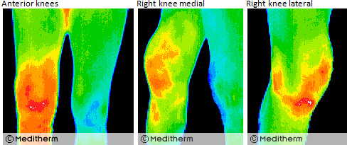 ThermApproach